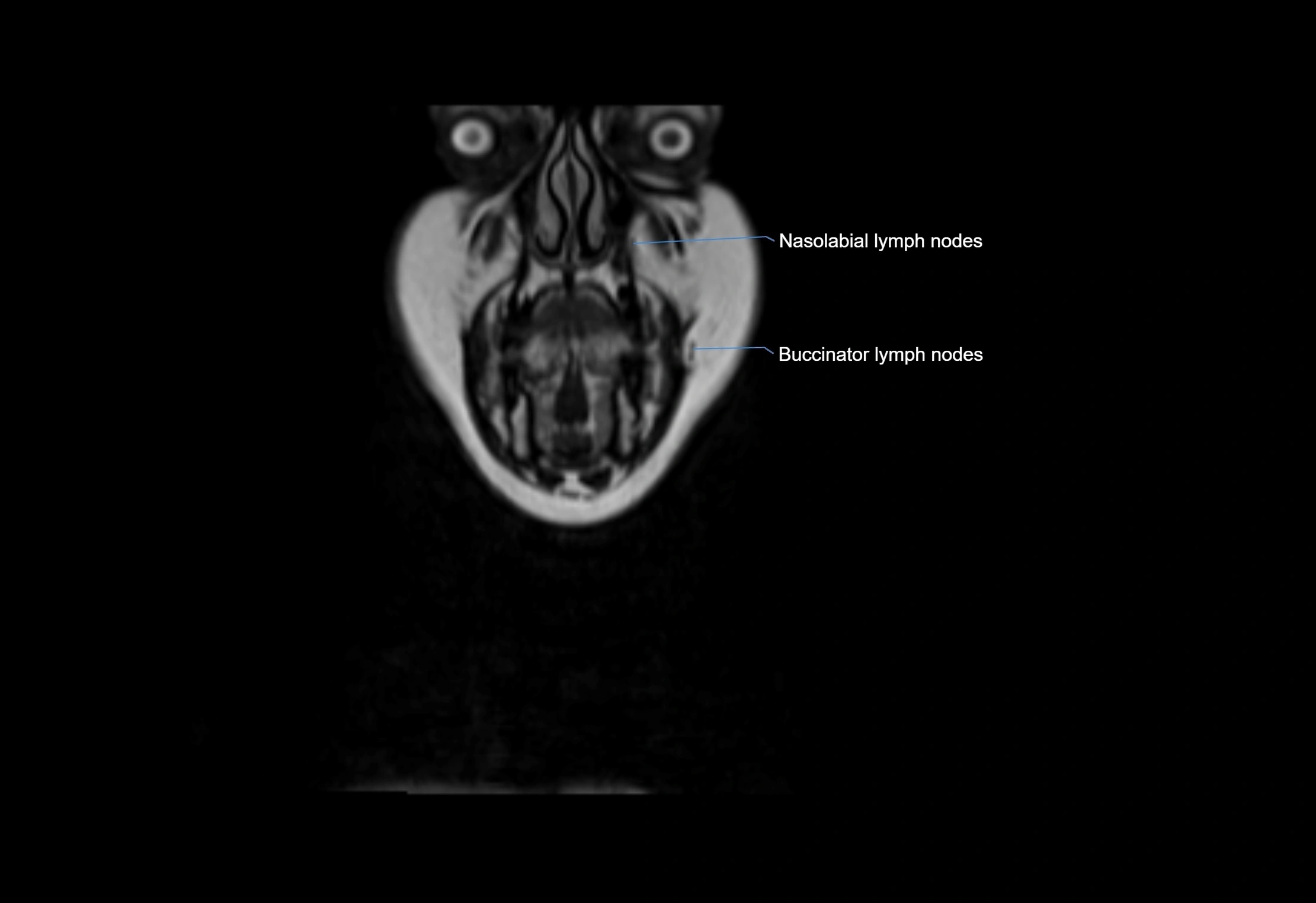 Neck coronal lymph node cross sectional MRI anatomy 3T MRI  image-img-00001-00070.webp